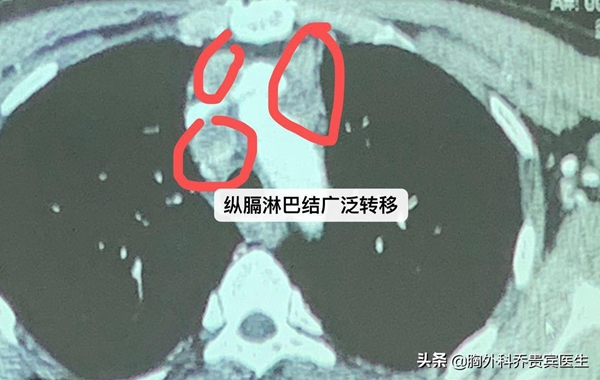 88岁老人肺部ct怀疑是肺癌,老人2cm肺结节是早期肺癌能活多久