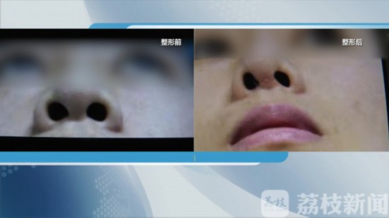 南京施尔美整形开眼角,施尔美微整形隆鼻价格