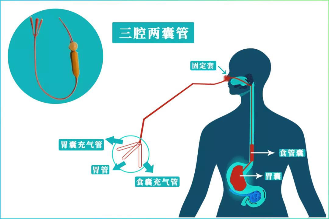 消化道出血发现黑便用什么药治疗,消化道出血导致的黑便是什么颜色