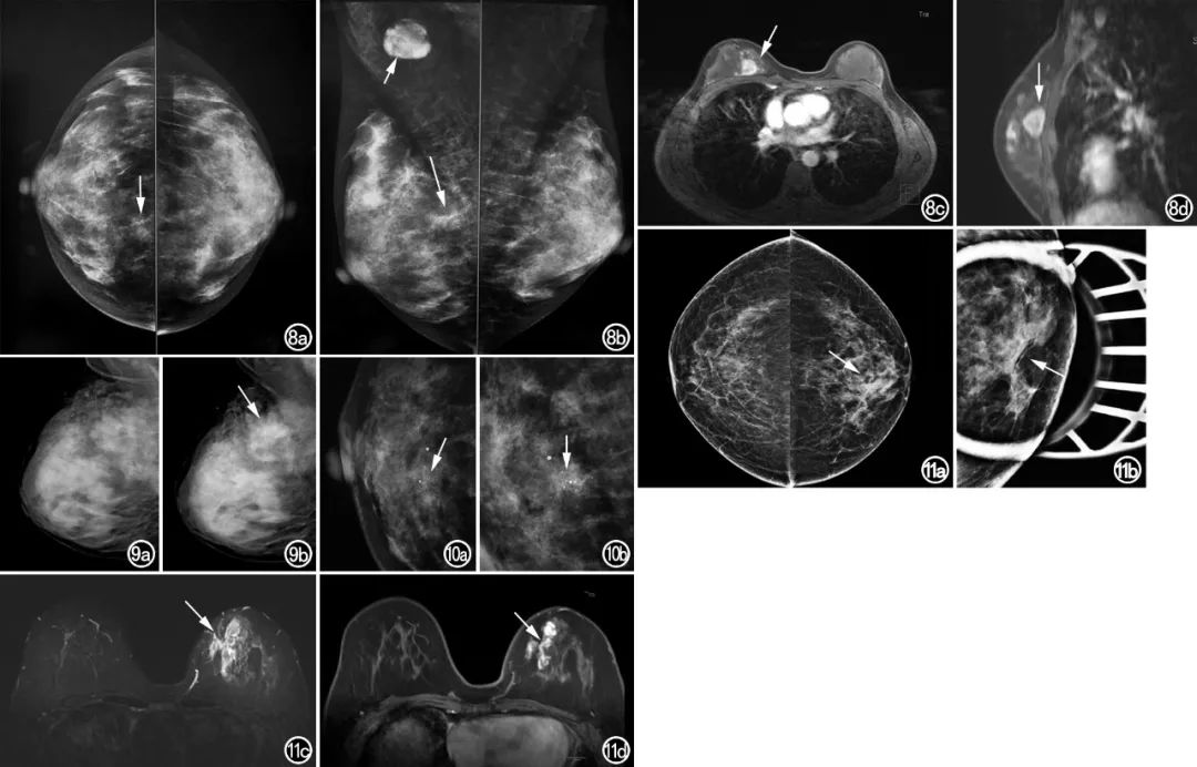 乳腺不对称是什么意思,乳腺结构扭曲及不对称正常吗