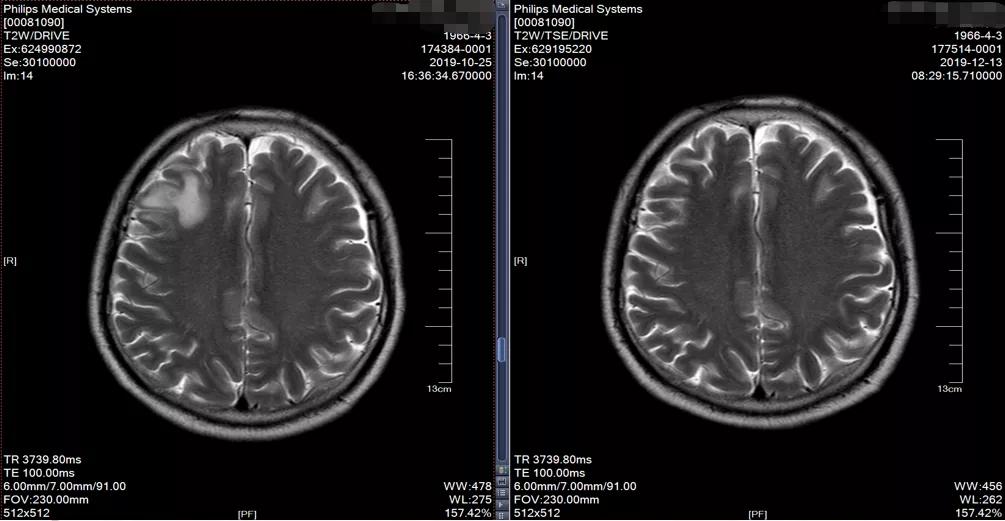 肺癌晚期可以靶向加免疫治疗吗,肺癌晚期化疗加免疫治疗有效吗