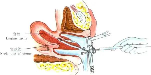 慢性子宫内膜炎的中医疗法,慢性子宫内膜炎的宫腔镜表现