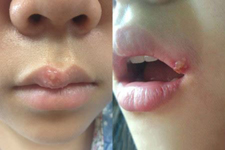 老年人嘴角烂是什么原因,小孩子嘴角烂是什么原因
