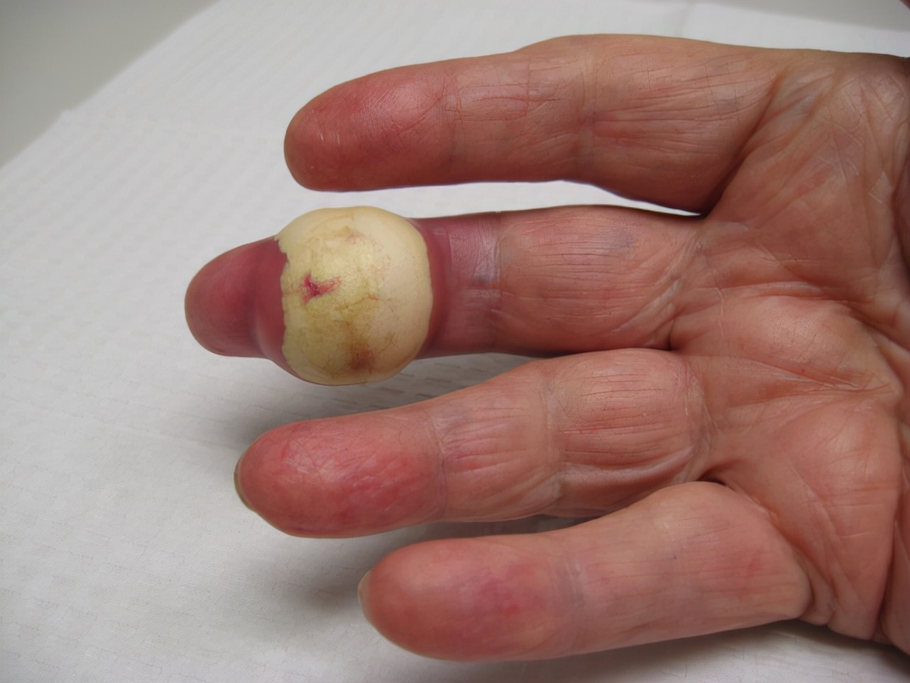 痛风的人很多，还在胡吃海塞？至少8000万国人正在受它折磨