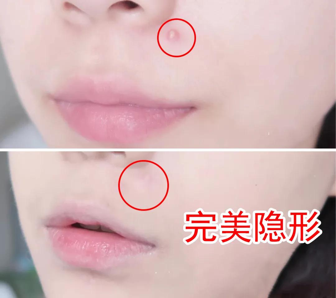 片仔癀祛痘痘产品,片仔癀可以改善痘痘肌吗