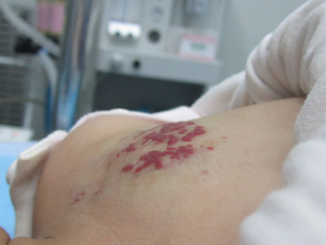 2岁女儿血管瘤,2岁小女孩肝血管瘤