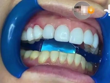 牙齿不漂亮做美容冠好还是矫正好,为了美牙去做根管治疗值吗