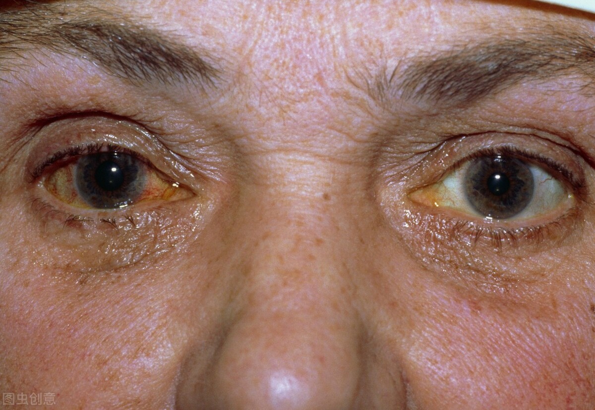 甲状腺眼病对眼睛的危害,甲状腺眼病视力怎么会下降的