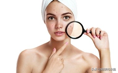 脸上部位长痘痘的原因分析图,脸上哪个部位长痘痘代表什么