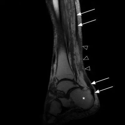杜兰特对猛龙跟腱受伤视频,伤病猛于虎下一句