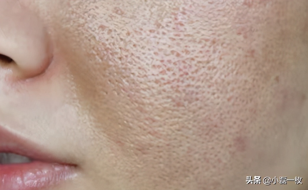 脸上长了小颗粒而且起皮特别糙,脸上皮肤又干又糙怎么办