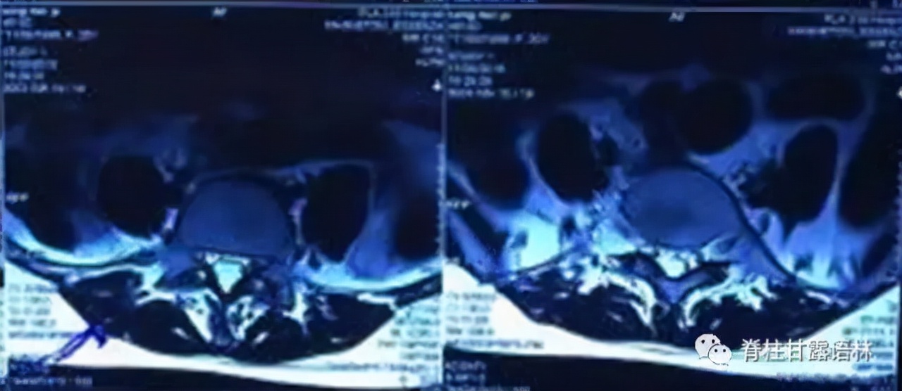 腰椎间盘突出中央型和旁侧型,腰椎间盘与椎板间隙的对应关系