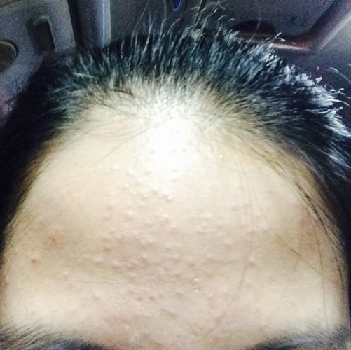 芦荟胶祛痘不祛痘,芦荟胶祛痘淡化痘印