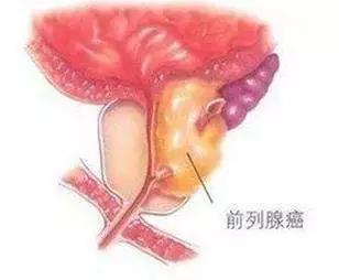 psa不高可能是癌症吗,psa升高代表疾病进展吗