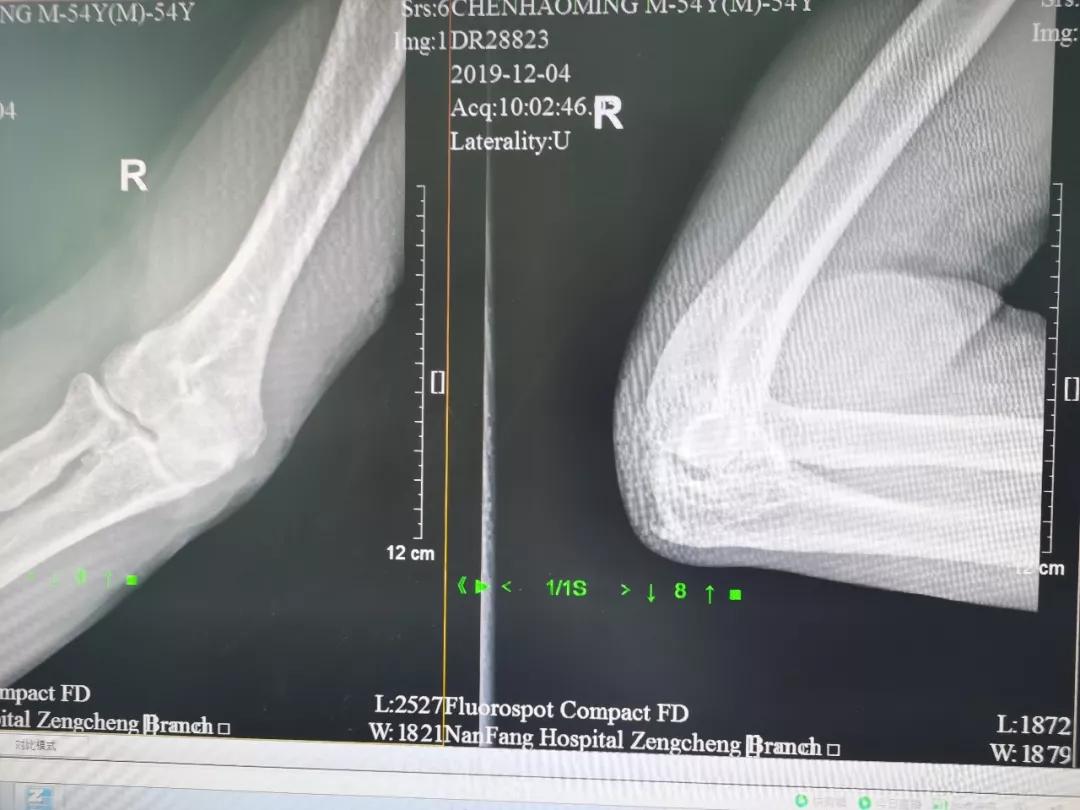 肩袖损伤肘关节旋转康复训练,肩关节损伤治疗微创视频