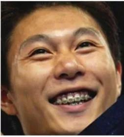 你与颜值和健康之间只差一个牙套,你与颜值巅峰只差一个发际线