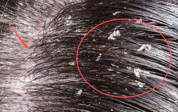 头屑越洗越多用什么洗发露,哪种洗发水去头屑最好最有效