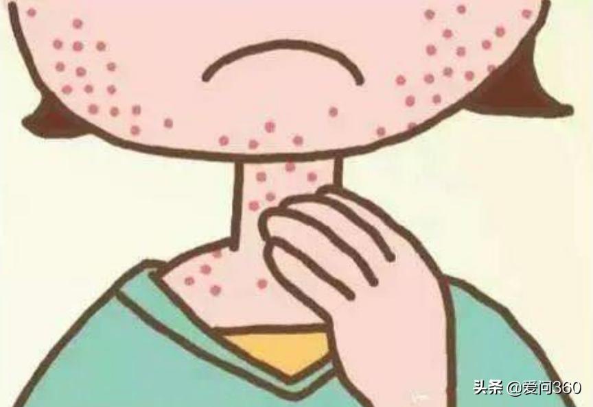 荨麻疹遇热重遇冷缓解怎么治,麻疹出现皮肤瘙痒用什么止痒