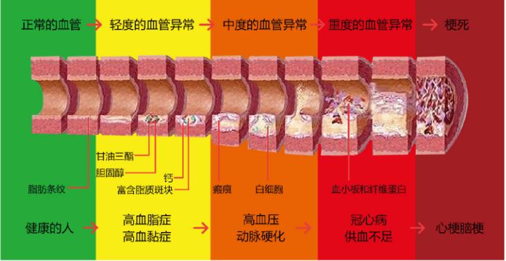动脉粥样硬化有哪些危险,动脉粥样硬化会导致脑血栓吗