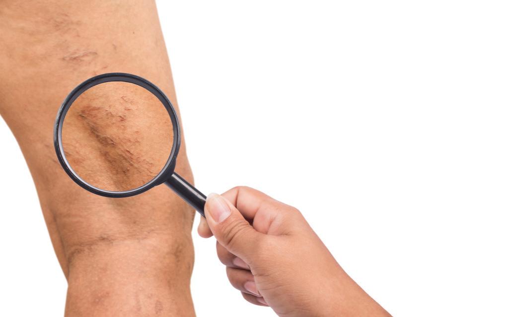 大隐静脉曲张淤积性皮炎,静脉淤积性皮炎图片