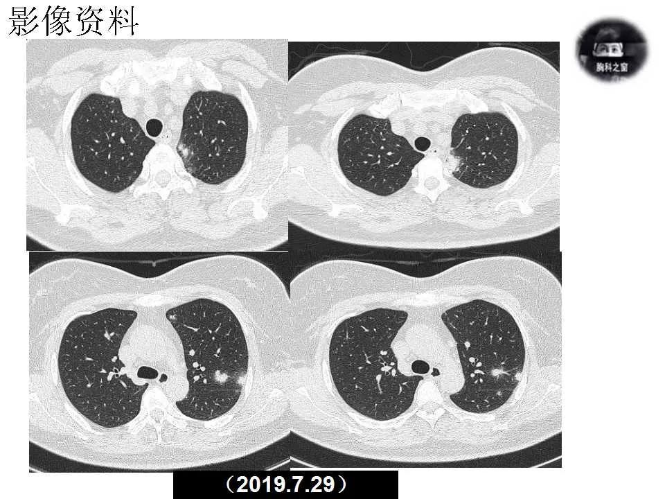 双肺多发结节是肺癌的征兆吗,双肺多发结节灶