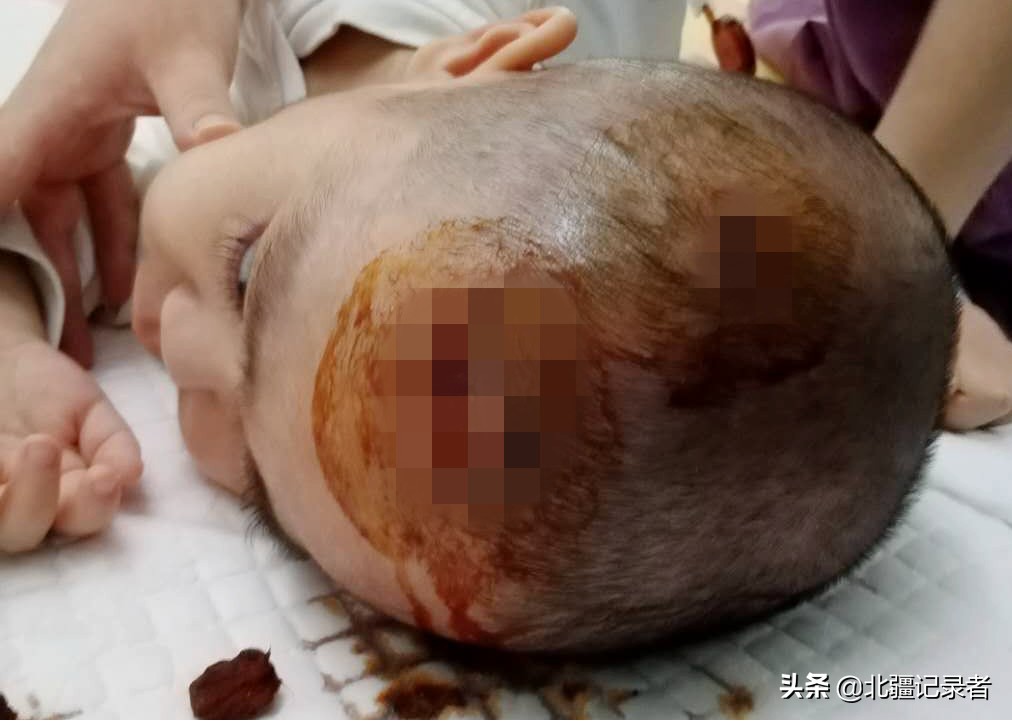 罕见病泡泡男孩,泡泡男童