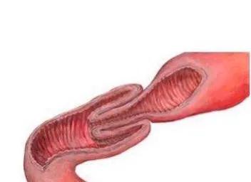 小儿肠套叠是什么原因发生的,小儿肠套叠有哪些症状表现