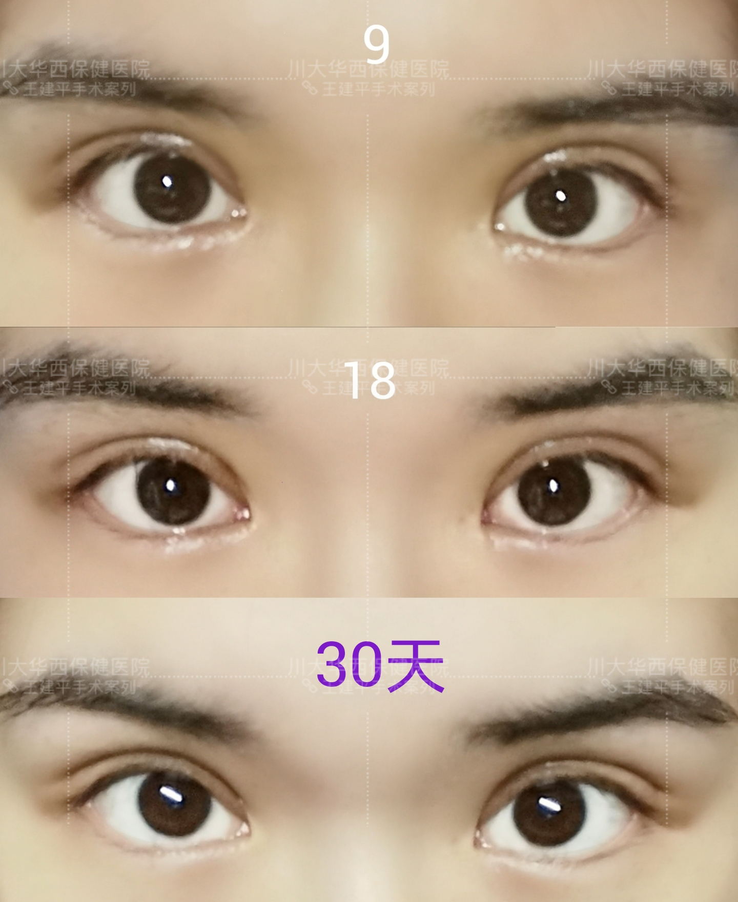 怎么知道自己最适合哪种双眼皮,双眼皮有哪几种类型图片