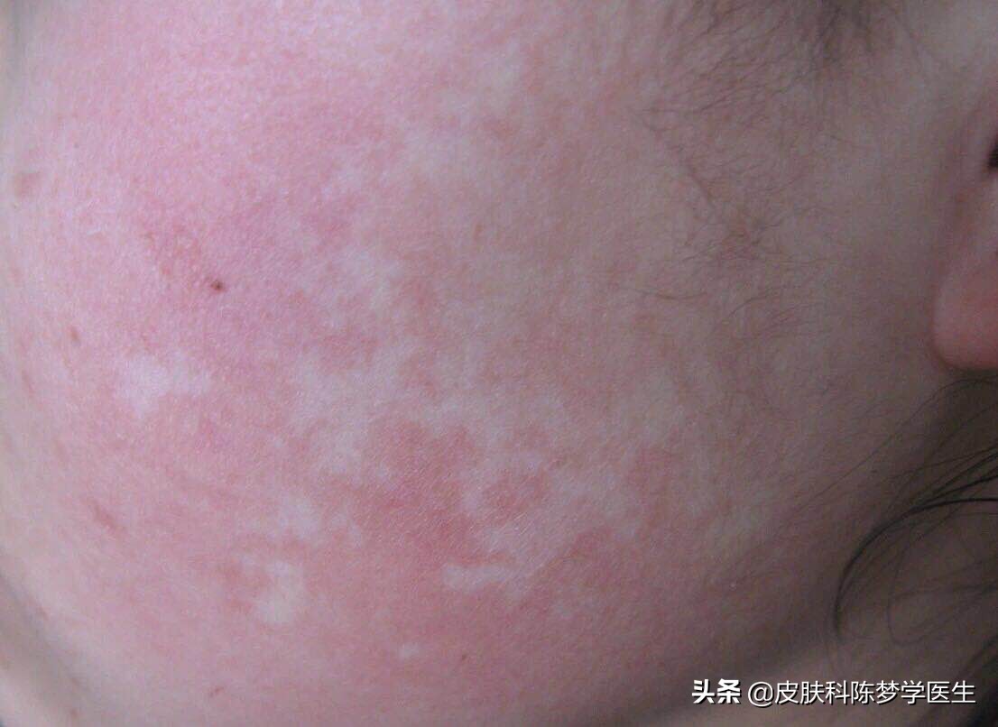 如何鉴别皮肤白斑是否是白癜风,皮肤长白斑用什么药膏