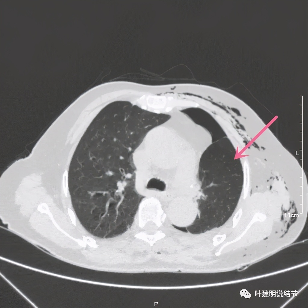 中央型肺癌手术前辅助治疗,中央型肺癌治疗后活过10年的病例