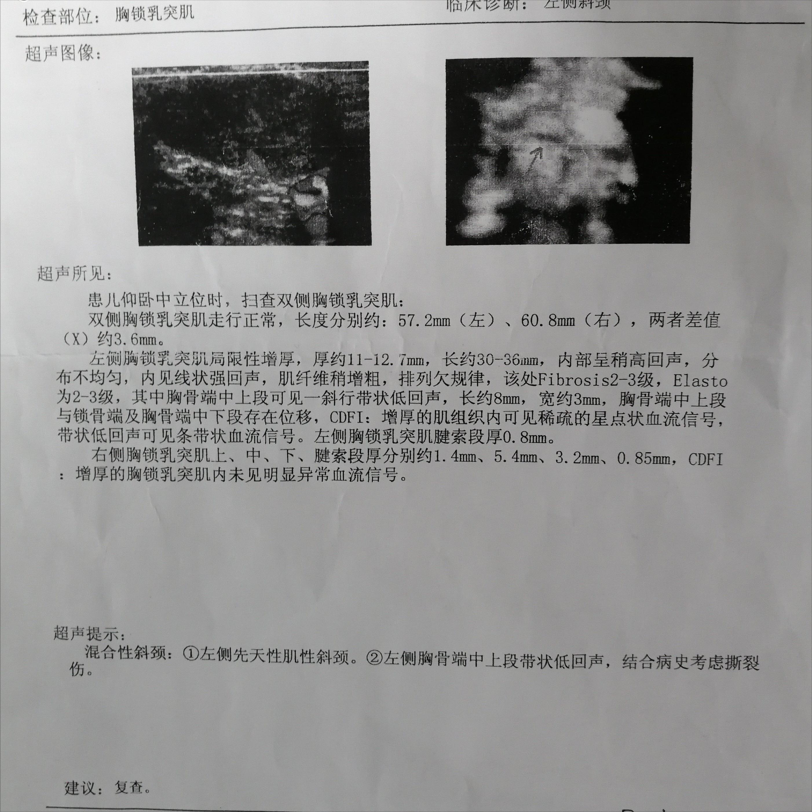 儿童神经系统引起的斜颈怎么治疗,哪个医院擅长治疗儿童斜颈