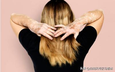 患白癜风要注意什么,患白癜风要如何治疗好呢