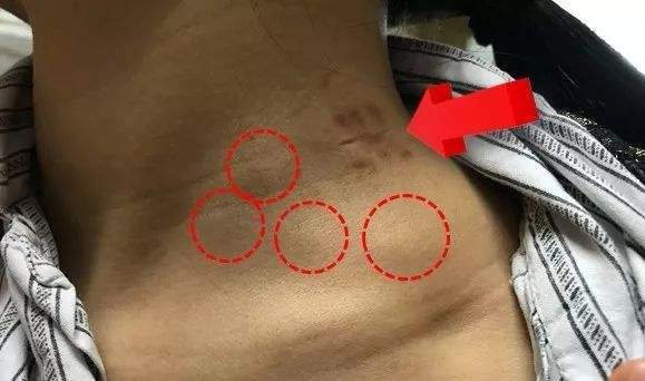 癌症辟谣,肿瘤患者辟谣