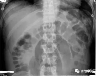 16种常见急性腹痛的诊断与鉴别