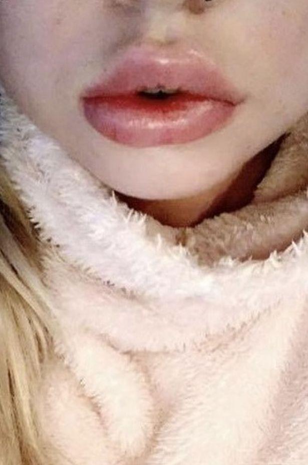 女子做丰唇手术超大嘴唇,做丰唇术嘴唇肿成香肠