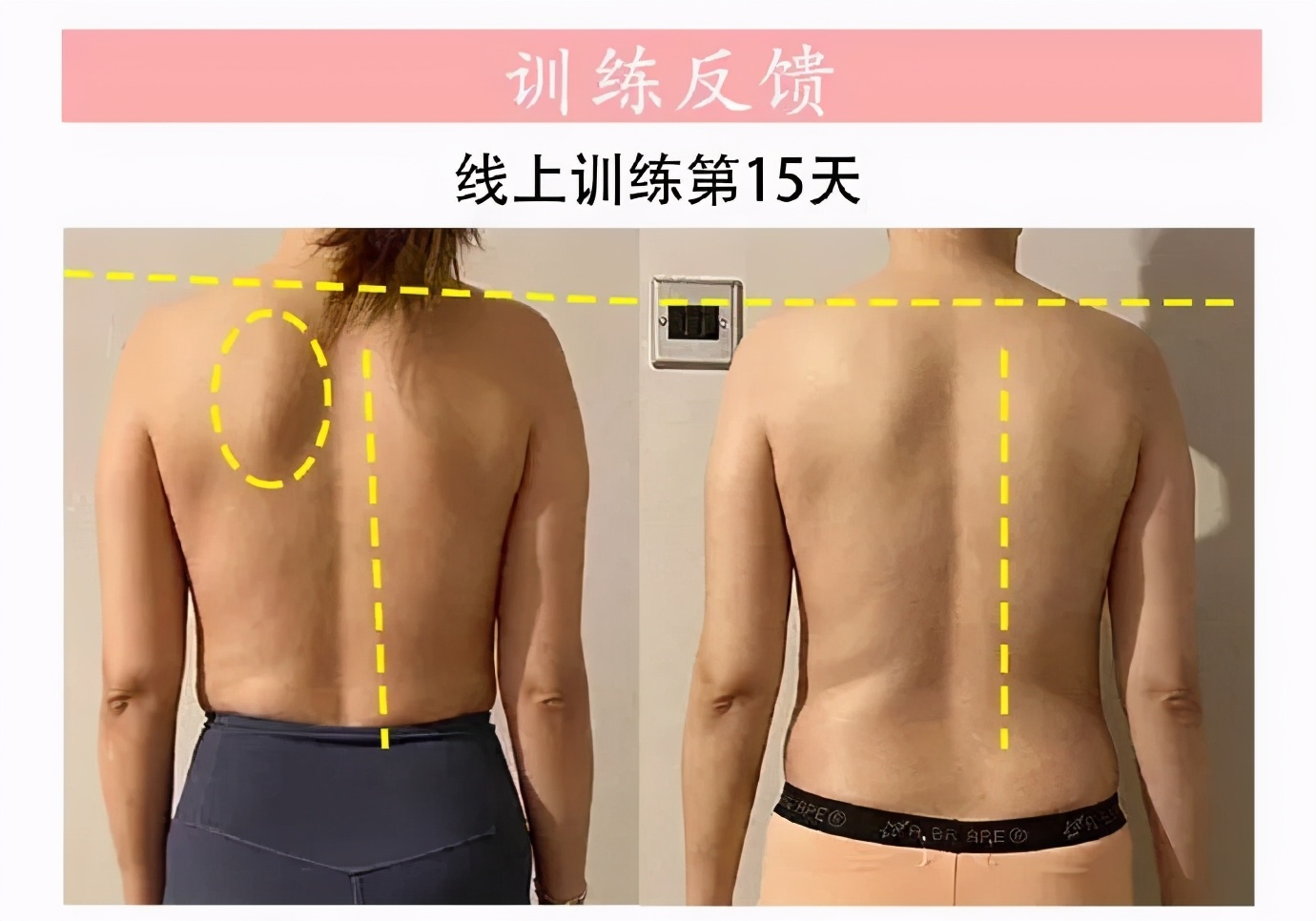 美背体态纠正,体态调整并开肩美背