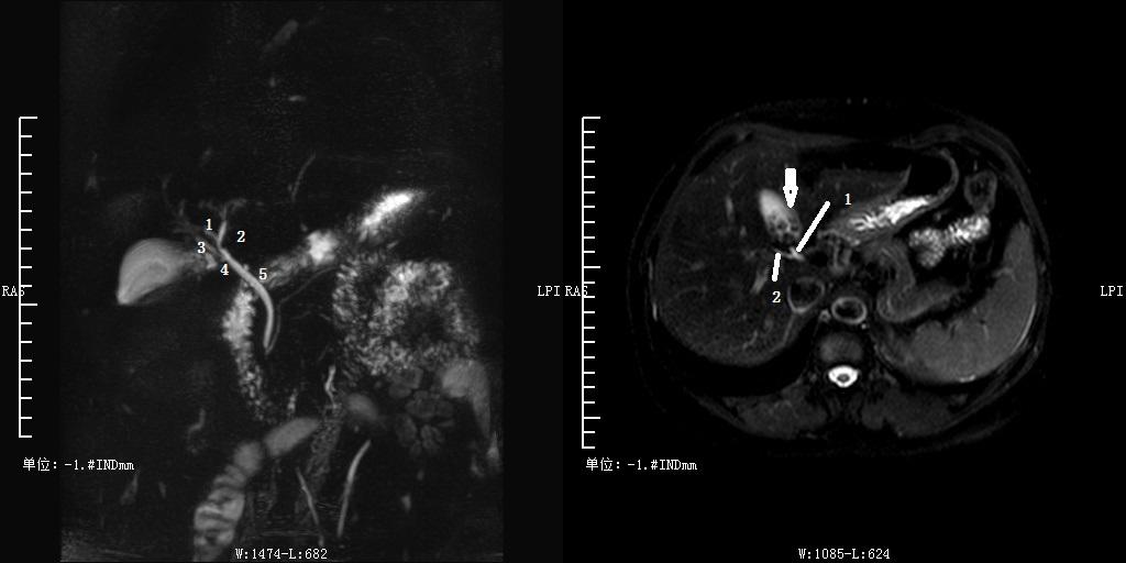 胆道系统解剖生理讲课视频,超声胆道系统的解剖生理