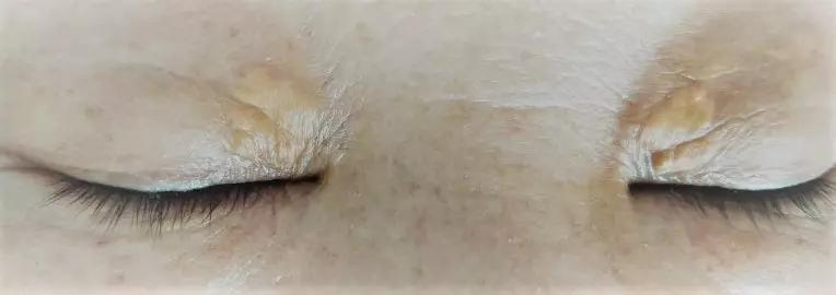 眼皮上的红色斑块是胎记吗,眼皮上长了黄色的斑块图片