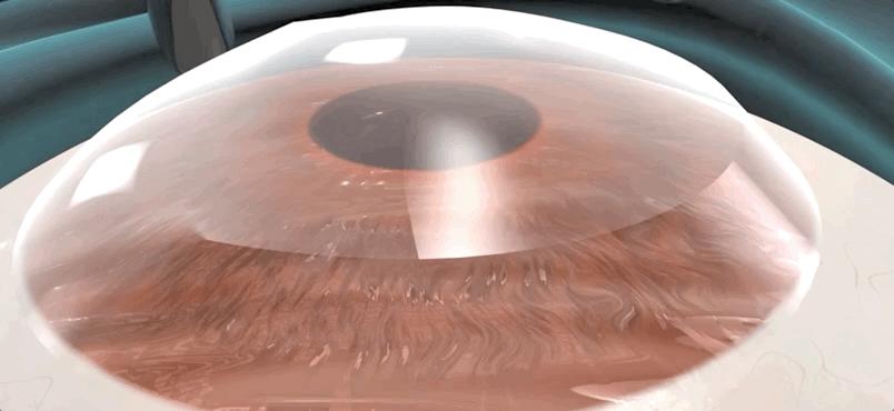 激光近视矫正手术有什么后遗症,激光矫正近视和散光有什么后遗症