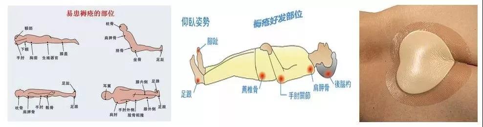 老年人跌倒后髋部疼痛是什么骨折,老人髋部骨折不治后果严重吗