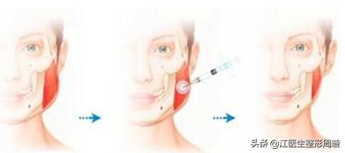 瘦脸针不要随便打,瘦脸针连续打几年真实感受