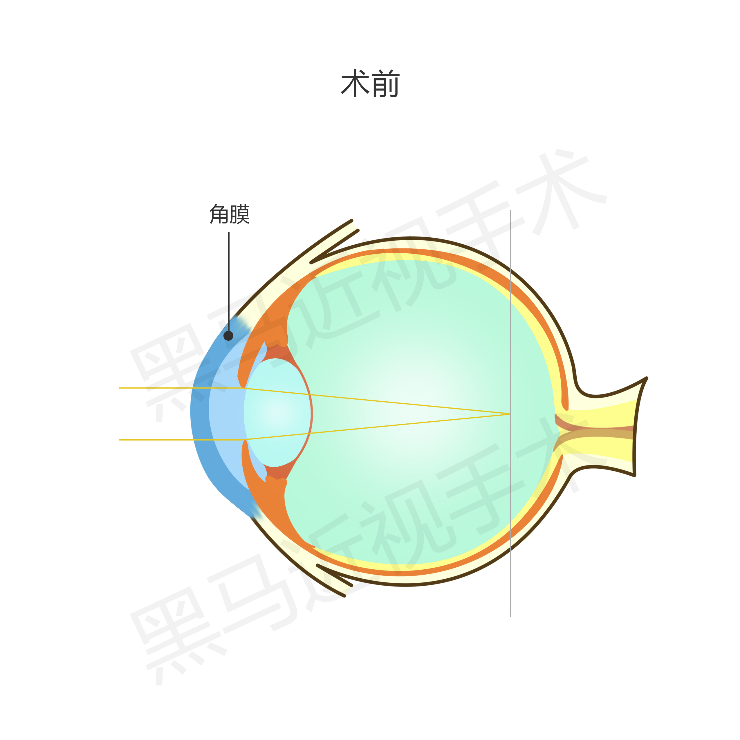 激光近视矫正手术有什么后遗症,激光治疗近视安全啊有没有后遗症
