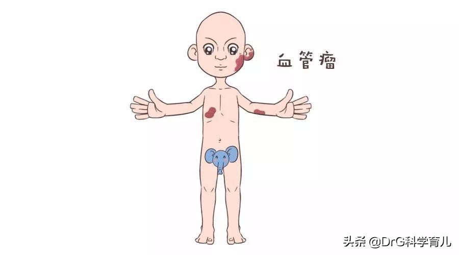 天生胎记黑毛痣会癌变会死吗,脖子上有个黑色胎记会癌变吗
