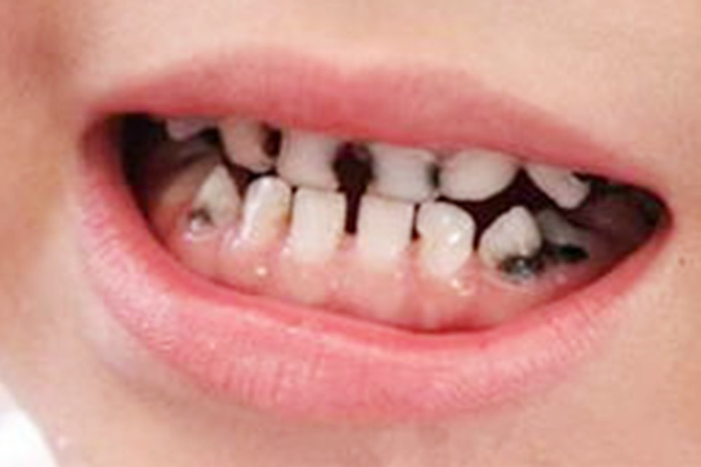 宝宝牙齿发黑被腐蚀,宝妈一个头两个大,看看以下办法能不能帮你