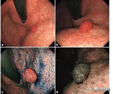 胃增生性肠息肉严重吗,胃体增生性的息肉是什么意思