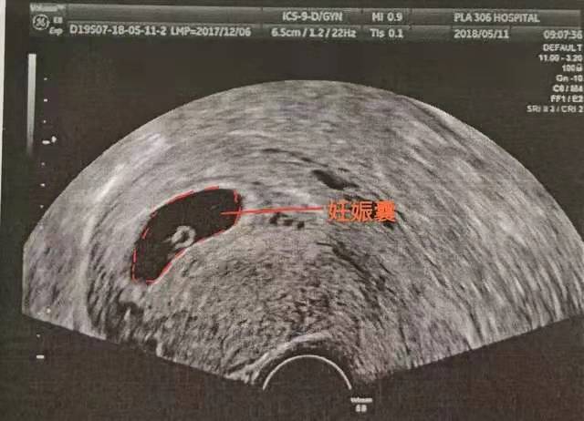 孕早期b超显示胎儿偏小怎么办,孕早期b超会不会误诊