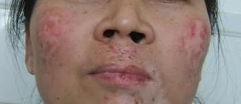 美容不成反毁容的案例,美容不做了皮肤会越来越差