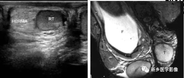 睾丸内部病变,睾丸病变mri