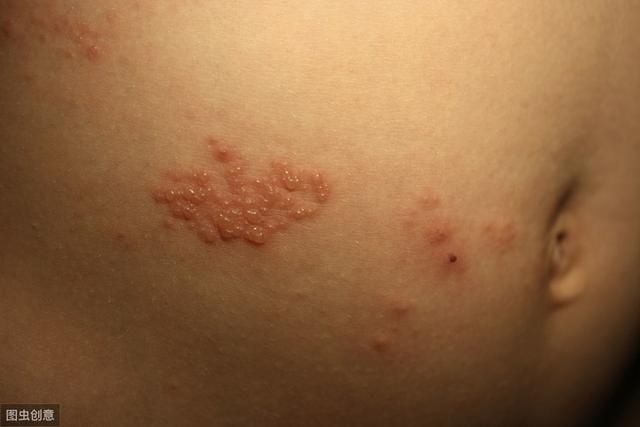 蛇盘疮围腰一圈会要人命吗,蛇缠腰和蛇盘疮是一回事吗