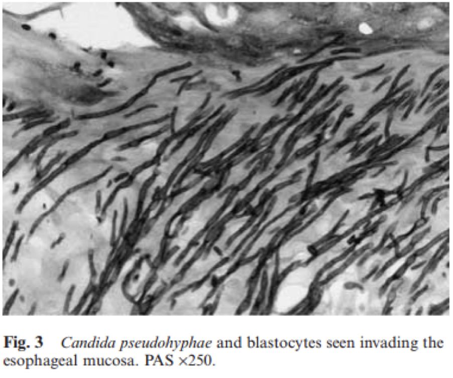 慢阻肺患者合并真菌感染,慢阻肺和真菌定植有关系吗
